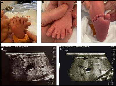 Bardet-Biedl syndrome caused by compound heterozygosity in BBS12 gene: a case report of one family with three affected members